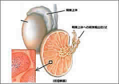精巣(睾丸)がんイメージ図